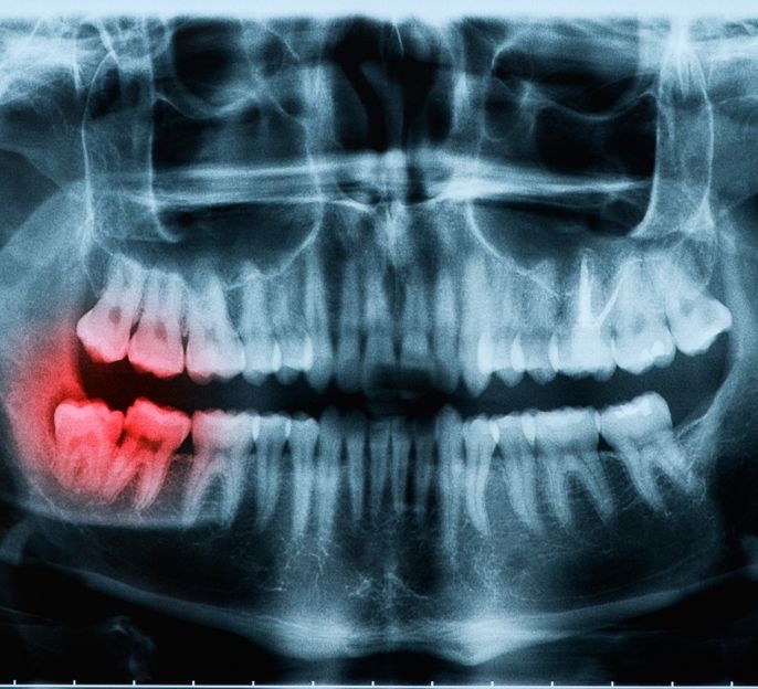 imagen de cirugia oral en Amorebieta clinica dental extraccion muelas del juicio